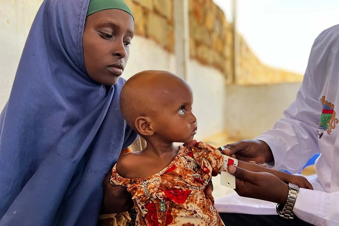 Mother and malnourished daughter gets arm measured and medical help.